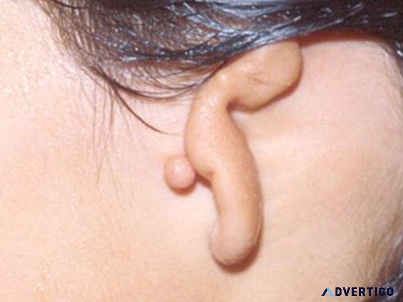 Ear reconstruction surgery- the microtia trust