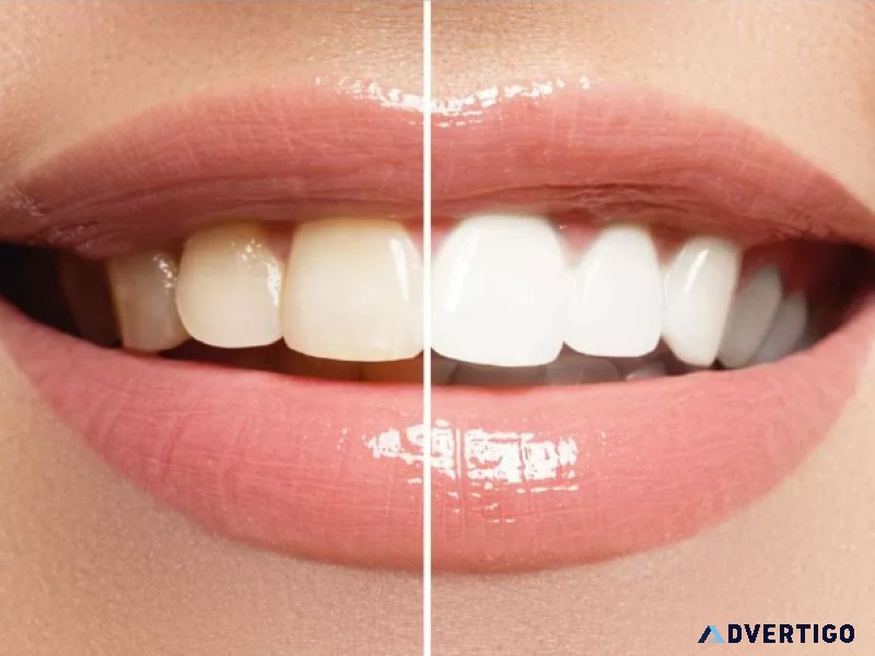 Best teeth whitening abu dhabi