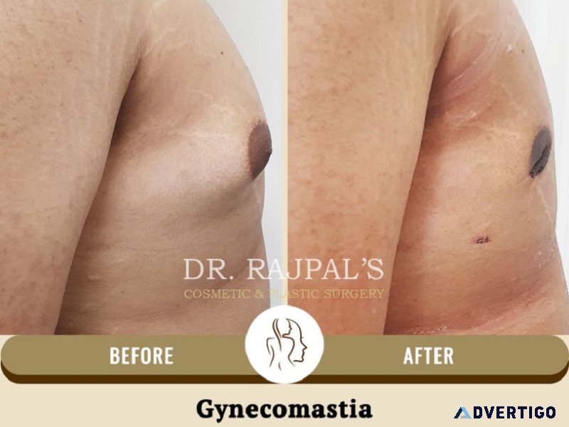 Gynecomastia surgery in delhi: it s a permanent treatment?