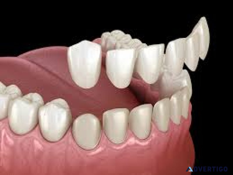 Dental veneers abudhabi