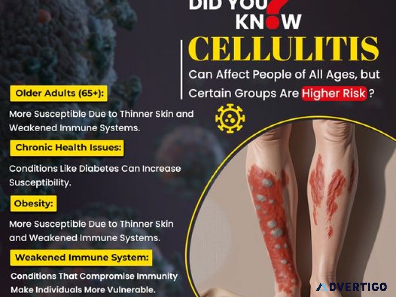 Cellulitis treatment | kbk multispeciality hospitals