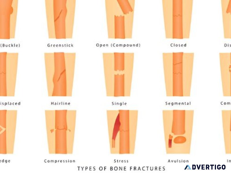 Types of fractures