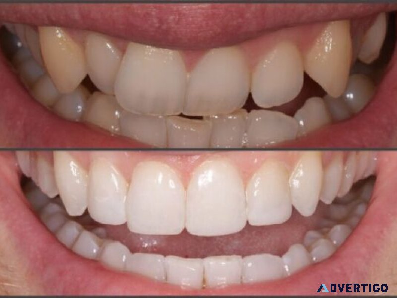 Why should you straighten teeth without braces?