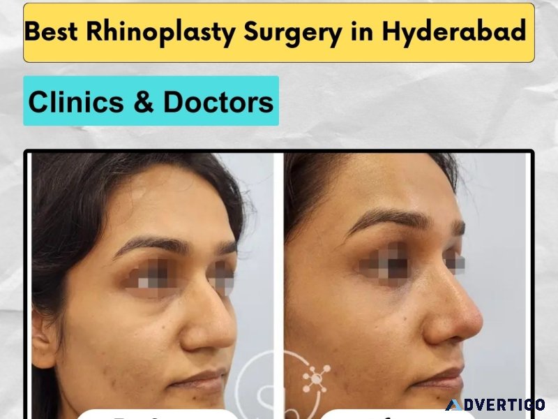 Best rhinoplasty surgery in hyderabad | clinics & doctors