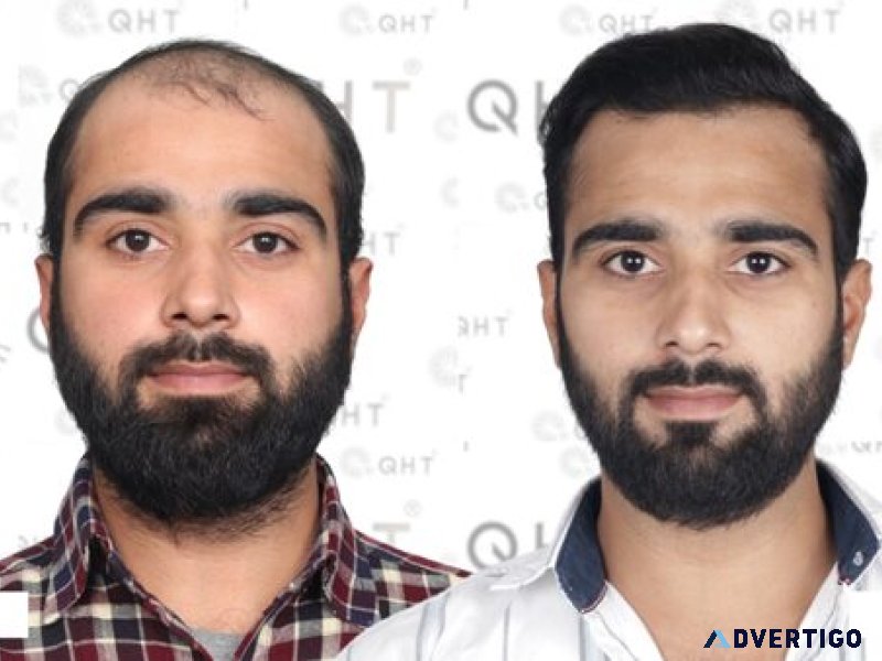 Affordable options for fue hair transplantation in india