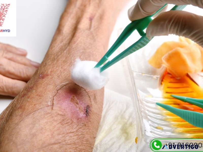 Diabetic wound care specialist in hyderabad | vascularhyd