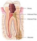 Save Your Teeth Through Root Canal Treatment