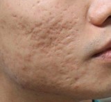 Acne Scar Laser Treatment in Gurgaon