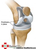 Knee Replacement in Delhi