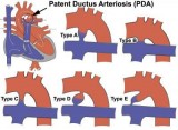 PDA Device Closure procedure in India  Healing Touristry