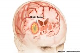 Get Brain Tumor Surgery at RGCIRC