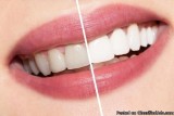 Get rid of teeth spots and scars easily by teeth whitening