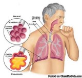 6 Best Homeopathic Medicines for ASTHMA Treatment