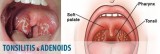 6 Best Homeopathic Medicines for Tonsillitis Treatment