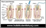 Dr. Philip Memoli - Root Canal Alternative Treatment by Holistic