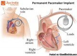 PPI-Permanent Pacemaker Implant - Double Chamber Cost in India