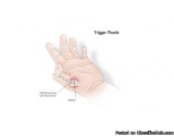 What Are the Most Common Symptoms of Trigger Thumb