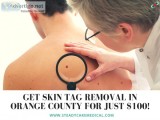 Get Skin Tag Removal in Orange County for just 100