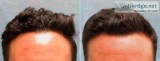 Get the Best Hair Loss Treatment at New Jersey