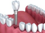 Dental Implants Plano TX