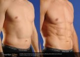 Liposuction Surgery in Houston