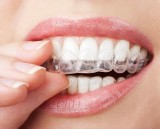 Teen Invisalign Without Braces  Holistic Dental Brunswick