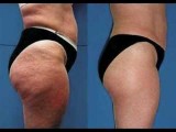 Get the Best Cellulite Treatment On Legs