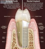 Dental Implant Dentistry In Roswell Georgia