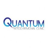 Tattoo removal consultation