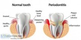 Gum Disease Treatment - Lakefront Family Dental