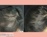 Best PRP Hair Loss Treatment in Chennai