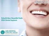 Permanent teeth in 3 days in India  LBR Dental Implants