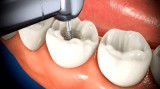 Root canals can impart a healthy smile