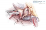 Septal myectomy in delhi