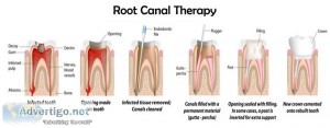 Best root canal treatment in delhi | root canal treatment cost i