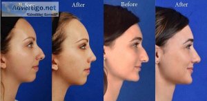 Most affective rhinoplasty cost in lahore