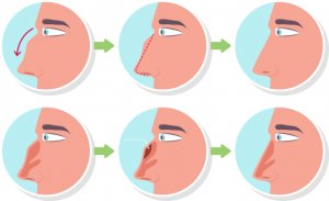 Best rhinoplasty surgeon in lahore