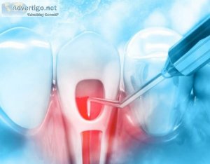 Dental implants in india