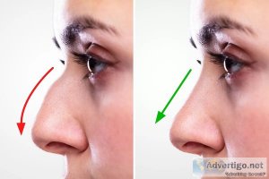 Rhinoplasty in lahore