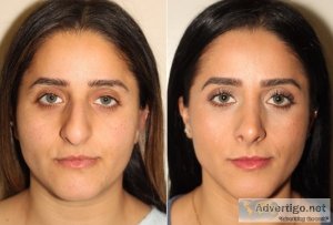 Rhinoplasty cost in lahore