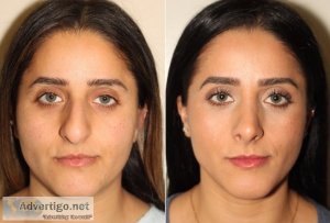 Best rhinoplasty surgeon in lahore