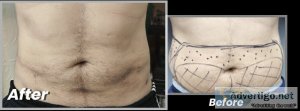 Liposuction surgery in lahore