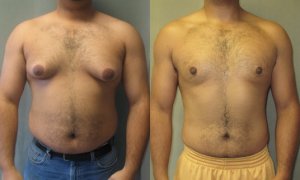 Gynecomastia surgery cost in lahore