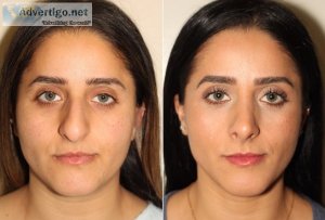 Rhinoplasty surgery in lahore