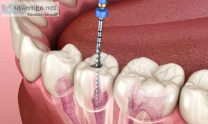 Painless root canal