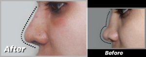 Best rhinoplasty surgeon in lahore