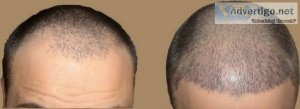 Hair transplant in islamabad