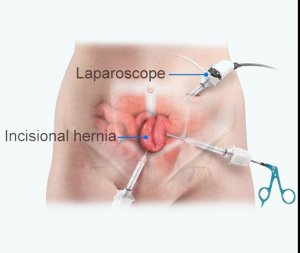 Hernia surgery cost in pakistan