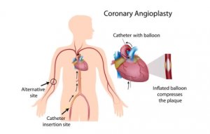 Coronary angioplasty & stent