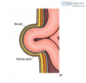 Hernia surgery